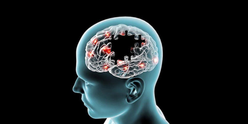 Alzheimer'ın Kesin Tedavisi Yok Ancak Mutlaka Yürüyüş Yapılmalı