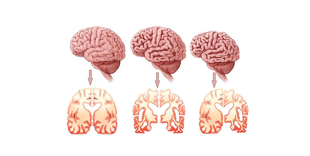 Türkiye'de 700 Bin Alzheimer Hastası Var